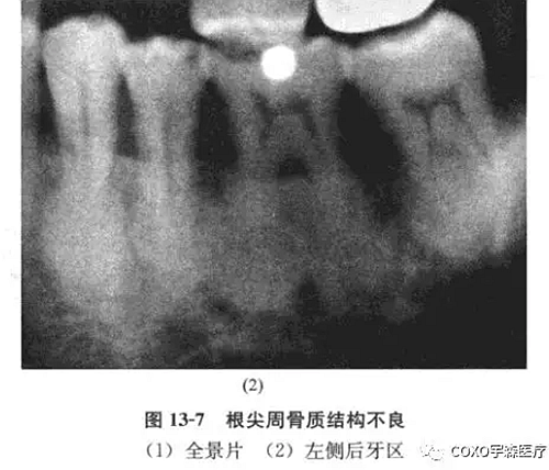 根尖周病與根尖周牙骨質結構不良