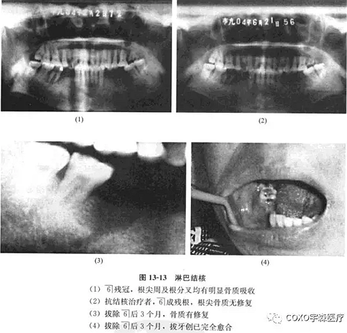 根尖周病與骨結核