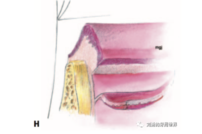 FGG游離牙齦移植在歷史上的各種改良以及發展前景