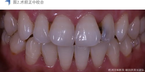 Vitique瓷貼面粘接系統的臨床應用