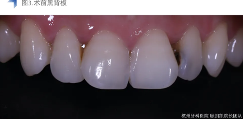 Vitique瓷貼面粘接系統的臨床應用