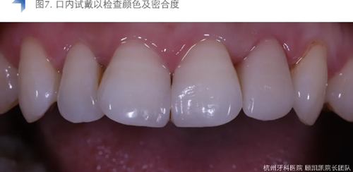 Vitique瓷貼面粘接系統的臨床應用