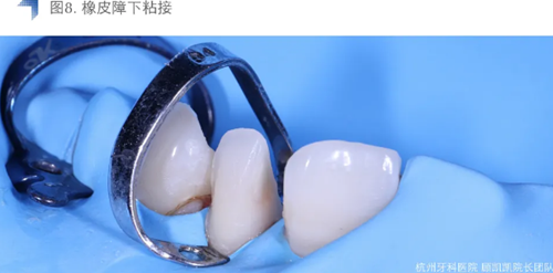 Vitique瓷貼面粘接系統的臨床應用