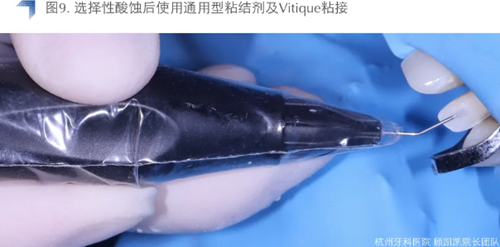 Vitique瓷貼面粘接系統的臨床應用
