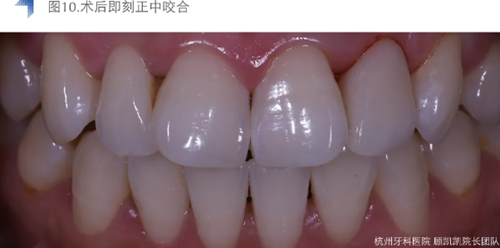Vitique瓷貼面粘接系統的臨床應用