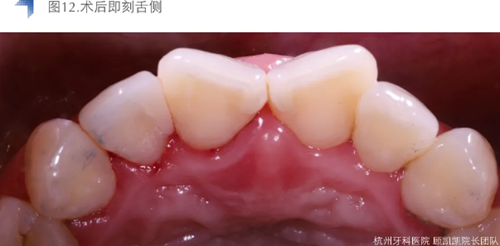 Vitique瓷貼面粘接系統的臨床應用