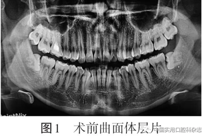 病例報告 | 下頜第三磨牙拔除術后并發雙側廣泛性皮下氣腫及縱隔氣腫1例報告