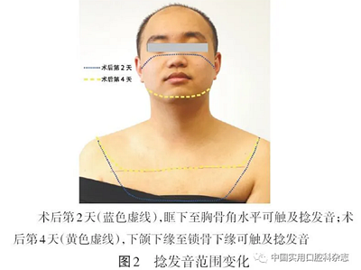 病例報告 | 下頜第三磨牙拔除術后并發雙側廣泛性皮下氣腫及縱隔氣腫1例報告