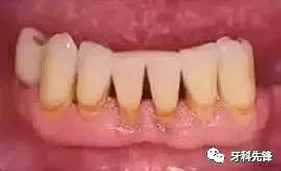 	牙齦萎縮是不治之癥？緩解牙齦萎縮5步走！