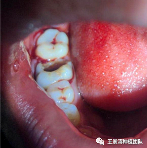后牙區(qū)即刻種植的適應癥的思考