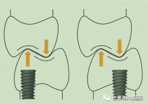 后牙區(qū)即刻種植的適應癥的思考