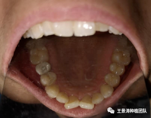 后牙區(qū)即刻種植的適應癥的思考